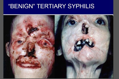 A photo of benign tertiary syphilis on a woman