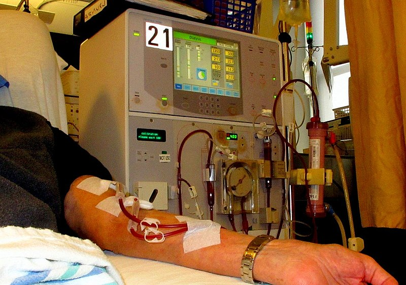A person in a hospital bed with a dialysis machine filtering the blood from the person's arm.
