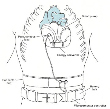 Electrically driven artificial heart system.