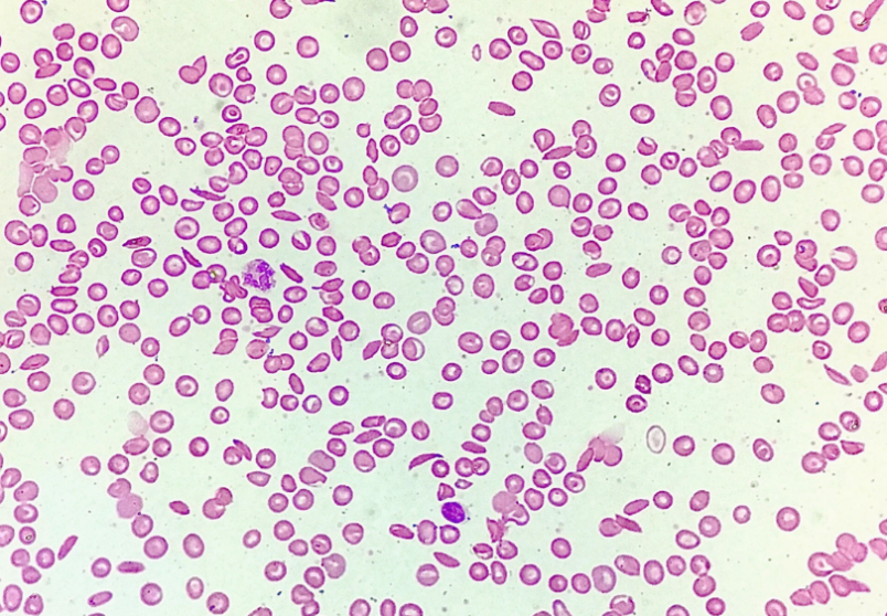 Microscopic image of blood smear showing normal and abnormally shaped red blood cells with normal concentration of white blood cells and platelets.