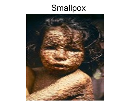 A photo of smallpox on a child