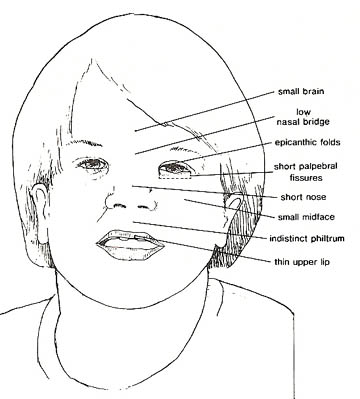 Facial features characteristic of FAS