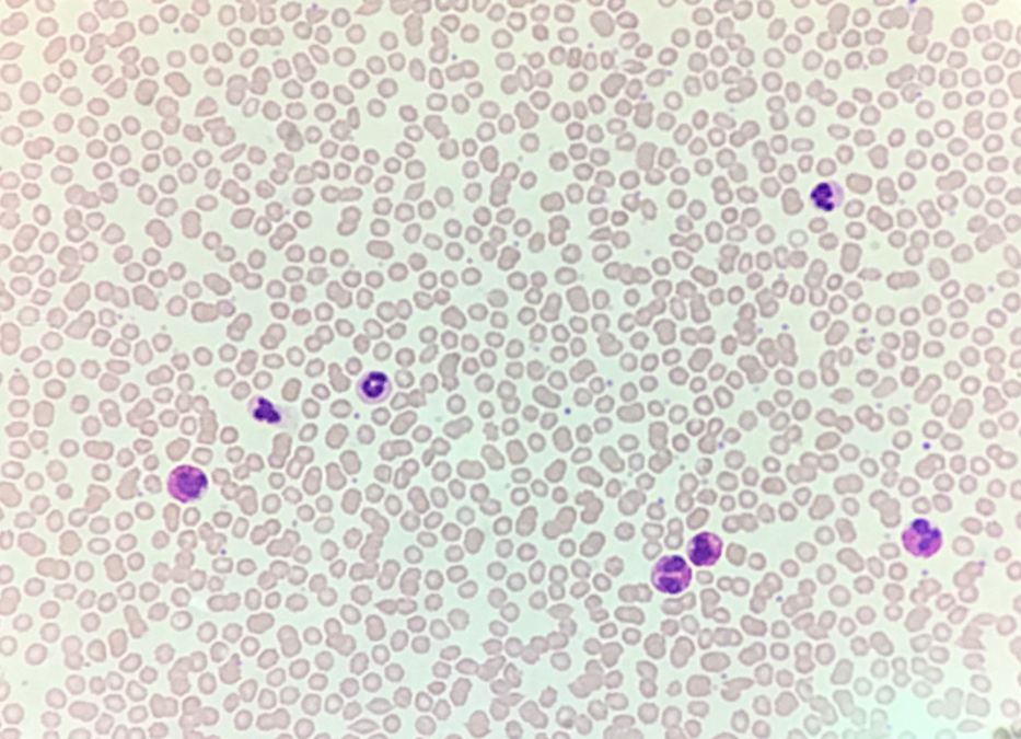 Microscopic image of a blood smear showing abnormal number of white blood cells, but normal number of red blood cells, and platelets.