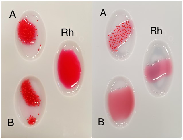 Image of two blood typing trays with synthetic red blood in wells marked A, B and Rh. These wells have been treated with antiserum.

Image on the left shows agglutination of wells A and B, but no agglutination of well Rh. Image on the right shows agglutination of well A, but no agglutination of wells B or Rh.