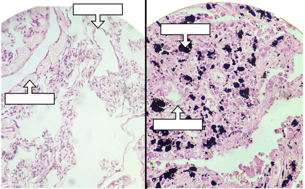 Two histology images of the lung. The image on the left shows two areas indicated with arrows and pink purple staining on the slide. The image on the right shows two areas indicated with an arrow and pink, purple staining on the slide with darkly stained (almost black) particles dispersed throughout the sample.