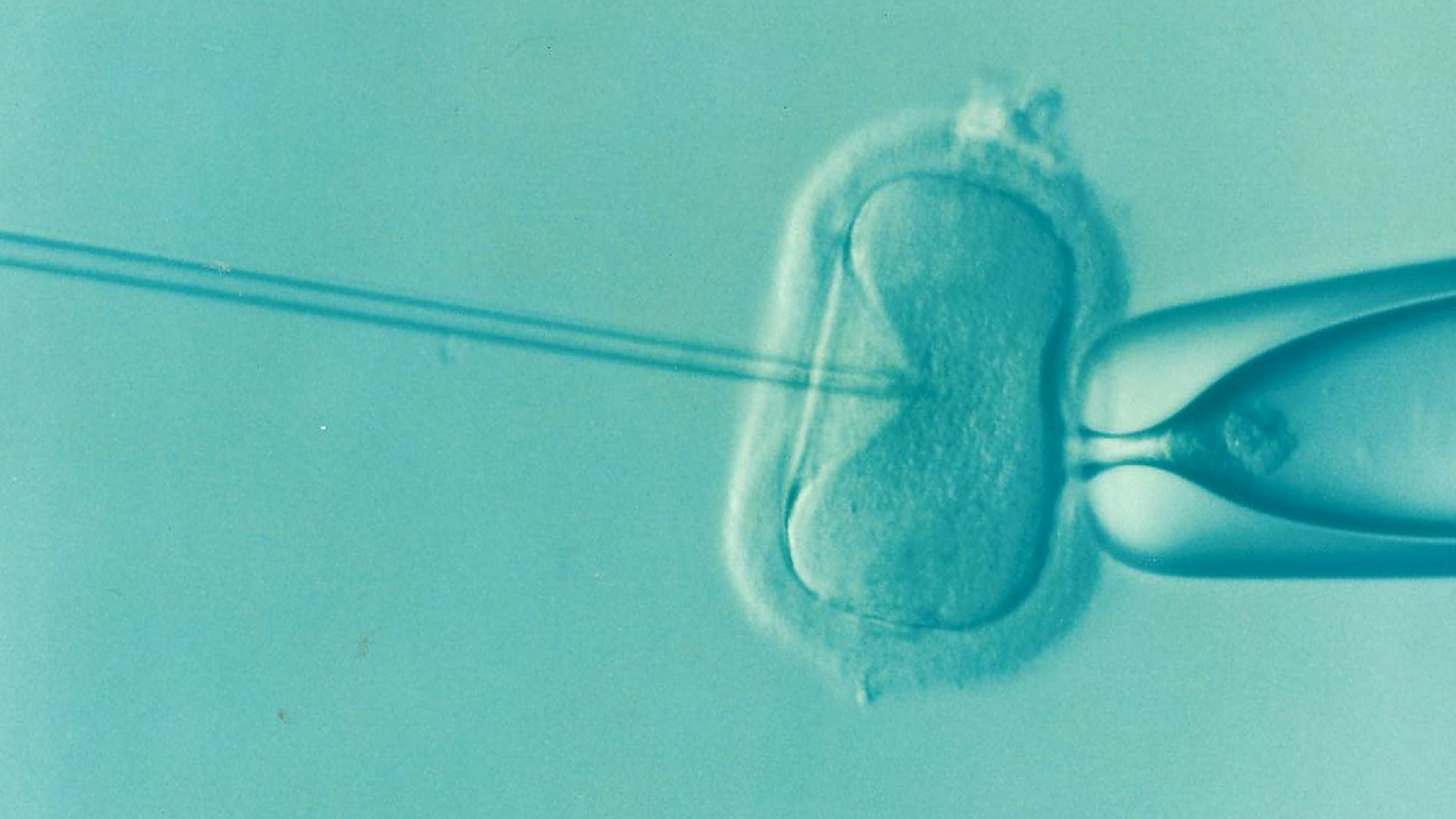 A microscopic image of the in vitro fertilization process. A human egg cell is being microinjected with a sperm cell.
