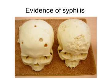 An image of evidence of syphilis on skulls